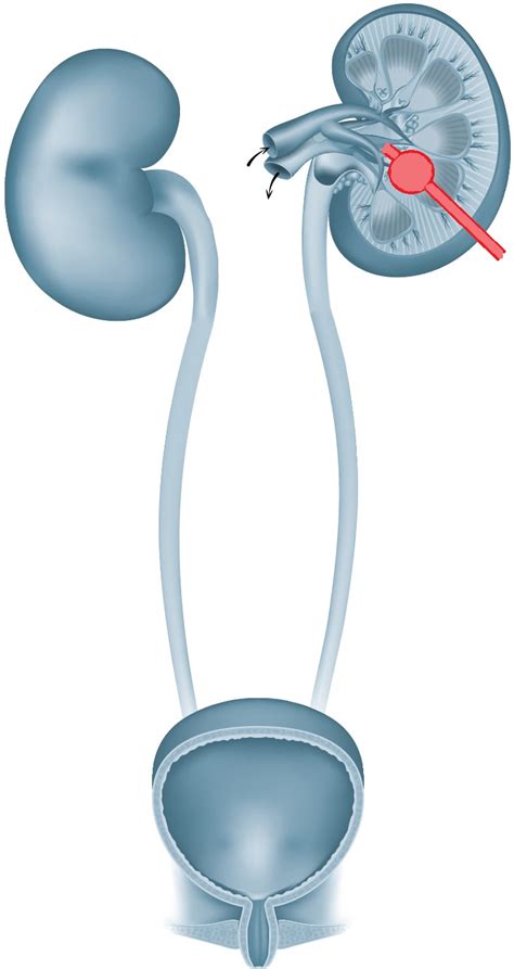 nierenkatheter|Nephrostomie 